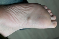 Definition and Phases of Plantar Fibromatosis