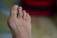Facts About Hammertoes