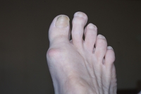 Understanding Morton’s Toe